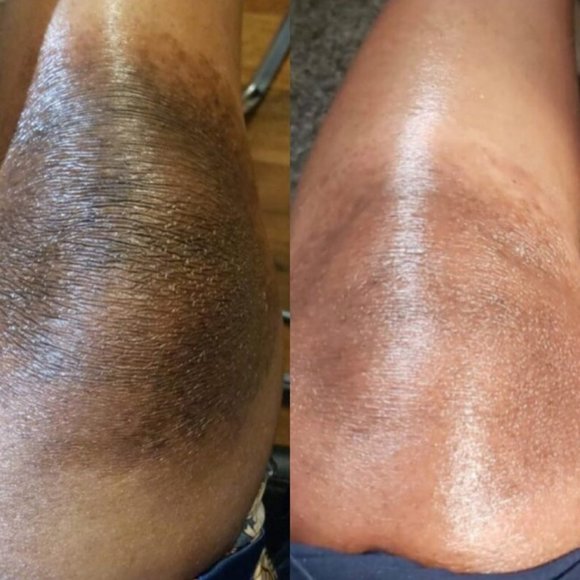 Dark Skin Bleach Body Bleaching Cream Max Strength Whitening Lightening - Picture 11 of 12